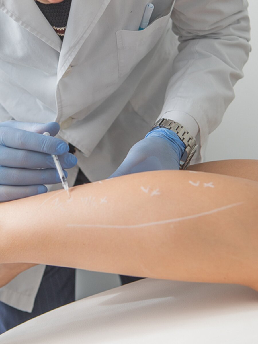 Calf Botox Injections